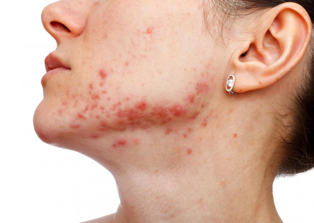 Some acne ointments include calendula.