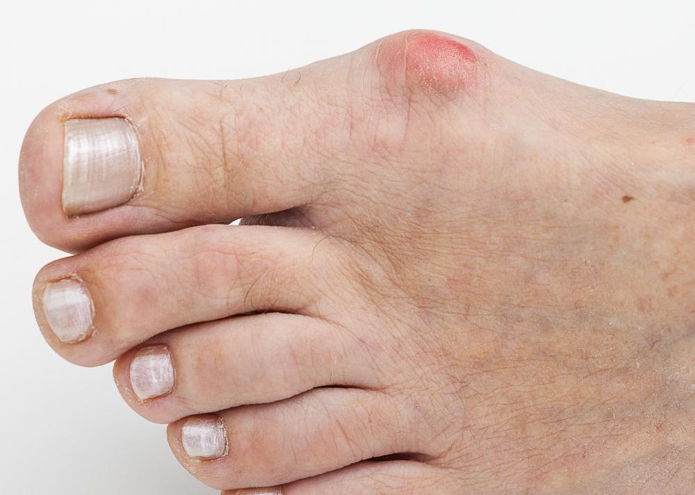 Some shoe stretchers are made specifically to protect bunions.