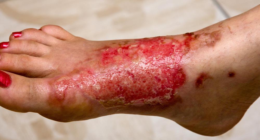 Installing a pressure balance valve on a home hot water system may help prevent scalding injuries.