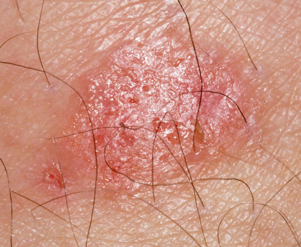 Infections caused by a fungus, such as ringworm, are often treated with an antifungal medication.