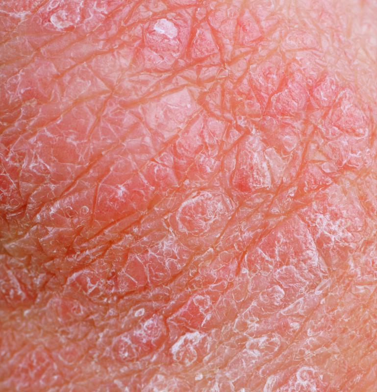 Calendula ointments can be beneficial for people with eczema.