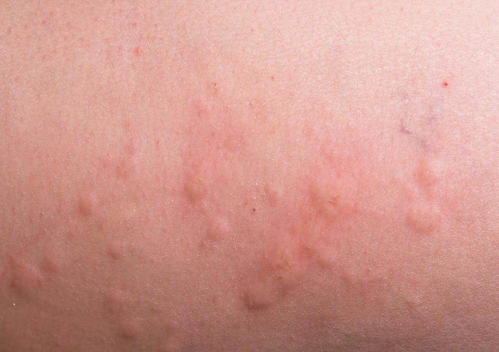 Hives are one possible side effect of formaldehyde exposure.
