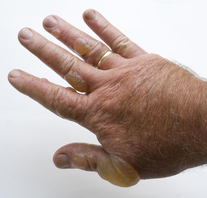 A man with poison ivy blisters on his hand.