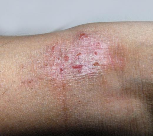 Topical witch hazel can be an effective treatment for eczema.