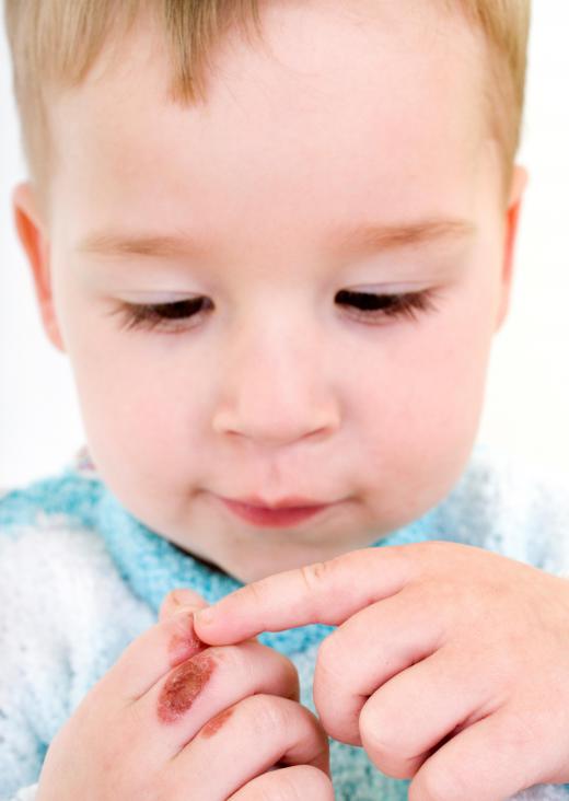Two seconds of exposure to water at 150 degrees will severely burn a child.