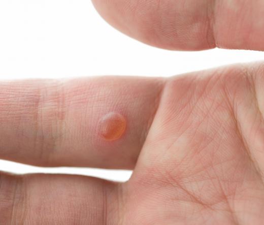 Duct tape is used in wart removal.
