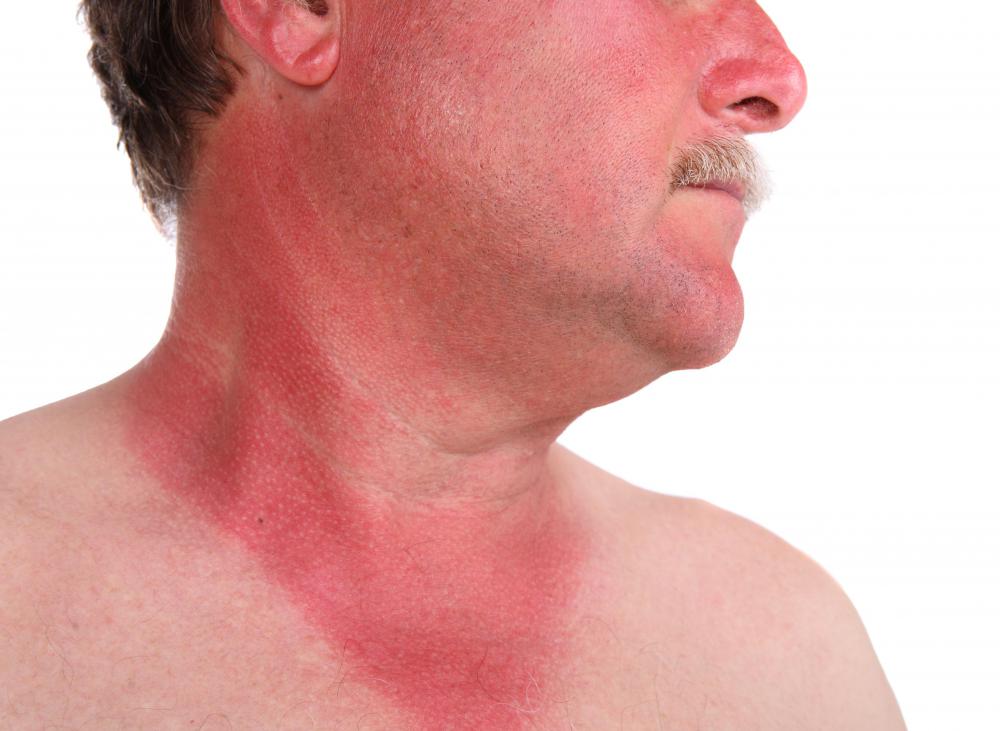 Calendula often is added to ointments to soothe sunburns.