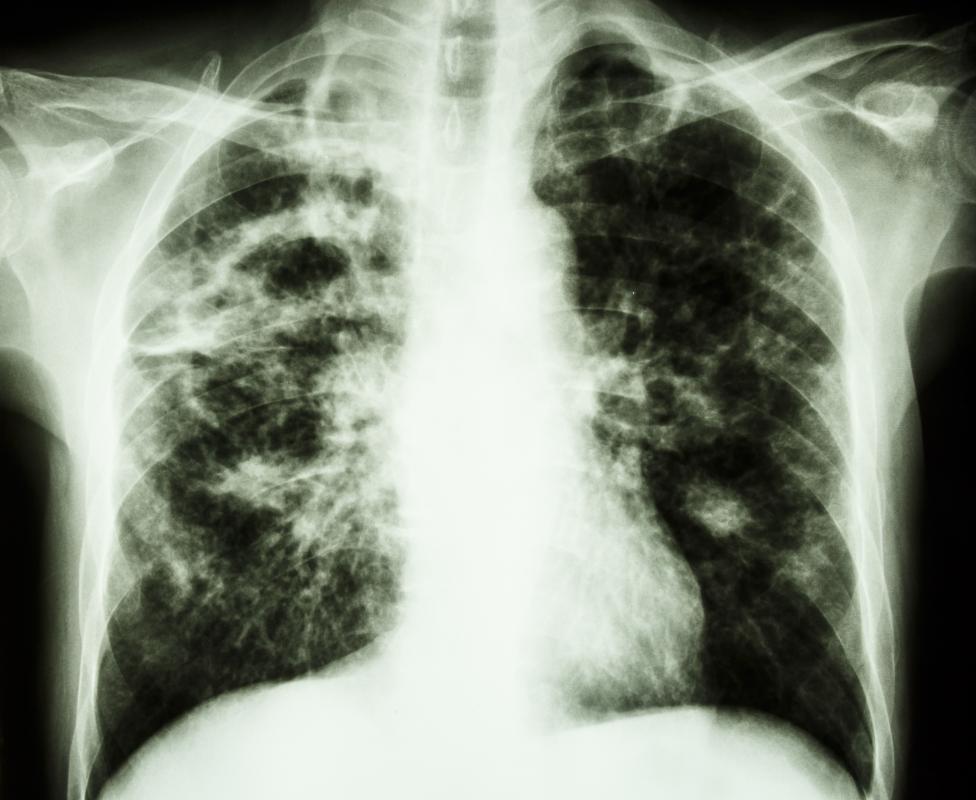 Tuberculosis patients often used sleeping porches.