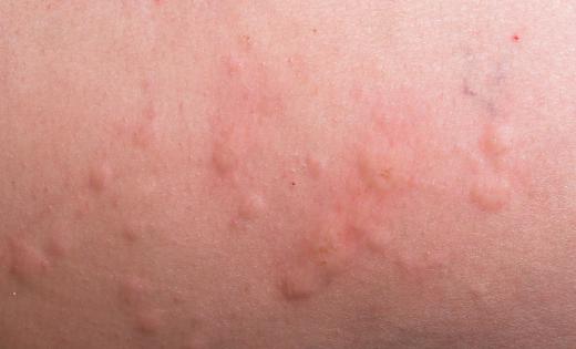 A rash may develop as a result of an allergic reaction to a pregnant onion.